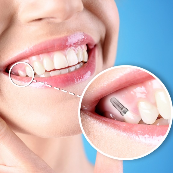 Nose-to-chin view of a woman smiling with one tooth indicated to be an implant via diagram